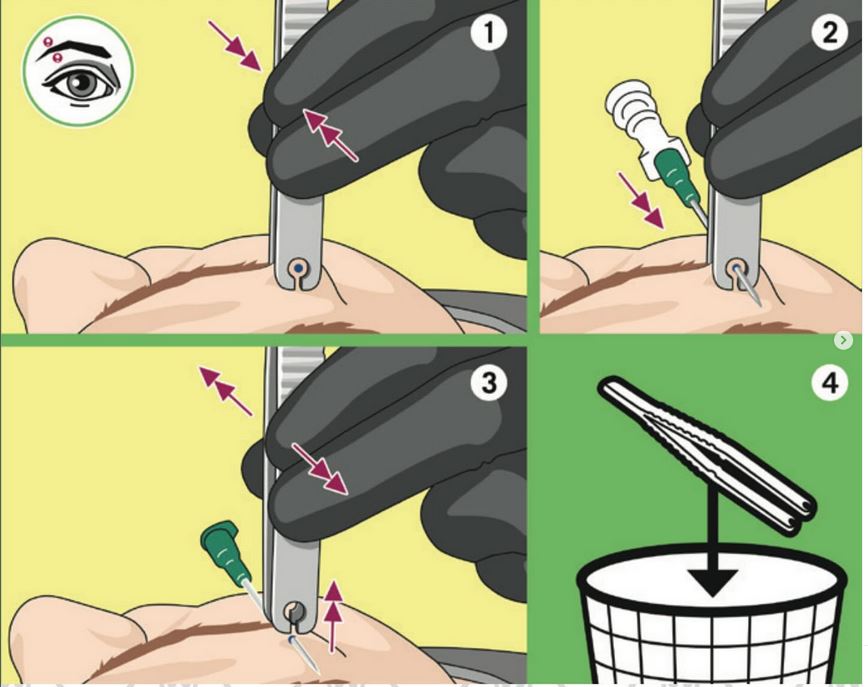 Snaptile Disposable Open Piercing Forceps (Round & Triangle)