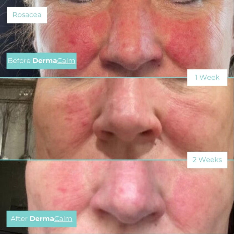 DermaCalm Rescue Mist (Various Sizes)